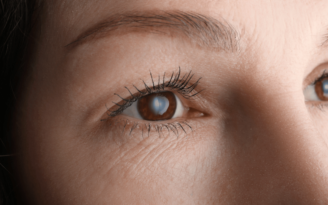 Cataracts: Everything You Need to Know