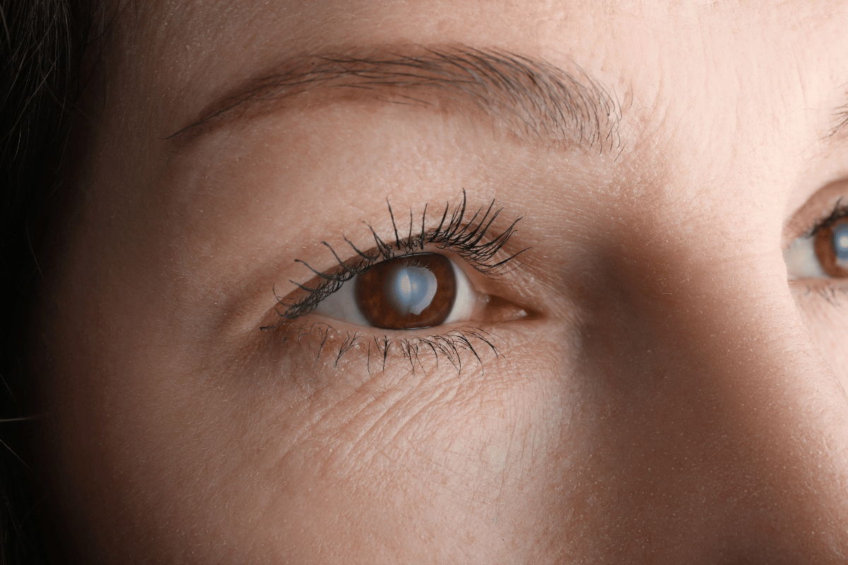 close-up shot of a woman's eye with a cataract