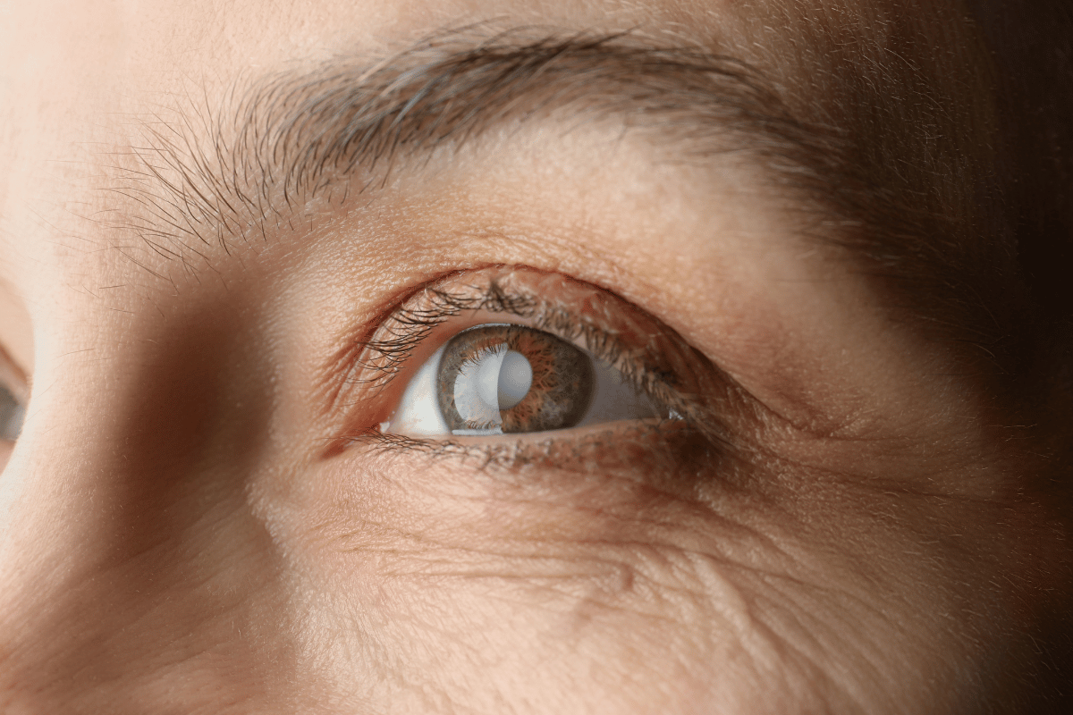 a close-up of an older woman's eye with a cataract